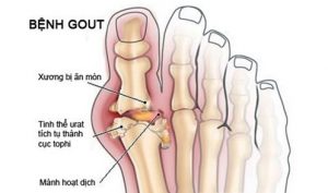 Bệnh gút Biến chứng của Gút.