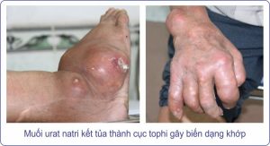 Biến chứng nguy hiểm của bệnh Gút.