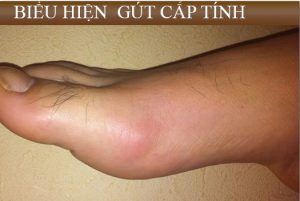 gút cấp tính ở giai đoạn đầu Biểu hiện của Gút cấp tính.