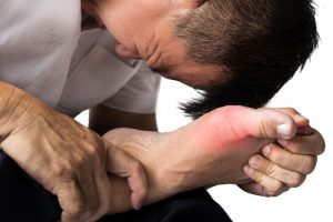 Đau ở khớp do bị gút Gút