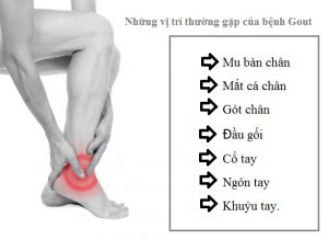 những vị trí thường xuyên đau của bệnh gút Vị trí đau