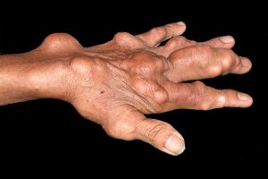 Gút gây sưng ở các khớp và biến dạng Gút