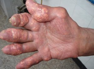biến chứng nguy hiểm của bệnh gút Biến chứng bệnh gút.