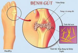 Ảnh mô tả bệnh gút Bệnh gút