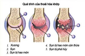 Bệnh thoái hóa khớp Thoái hóa khớp
