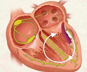 Bệnh thấp tim Bệnh thấp tim