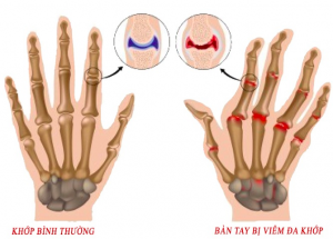 Bệnh viêm đa khớp Viêm khớp