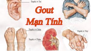 Kinh hoàng bệnh gút tàn phá cơ thể người bệnh benh-gut