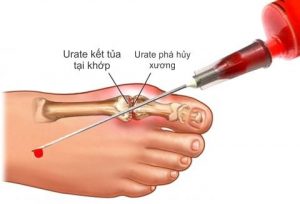 Gút phá hủy xương khớp benh-gut-pha-huy-xuong-khop