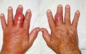 benh-gout