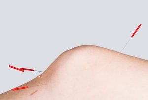 Chữa bệnh gút bằng phương pháp châm cứu phuong-phap-cham-cua-chua-benh-gut