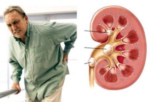 Thận suy yếu là nguyên nhẫn tới gút than-yeu