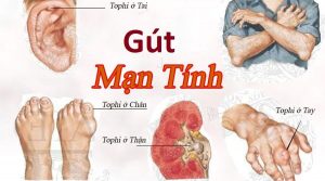 benh-gut-man-tinh