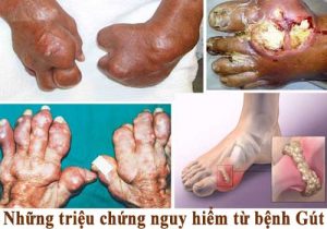 Biến chứng nguy hiểm của bệnh gút bien-chung-nguy-hiem-man-tinh